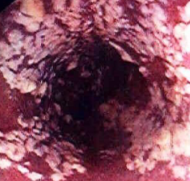 What is Leaky Gut Syndrome?